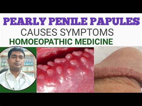 Diagnosis and Management of Pearly Penile Papules